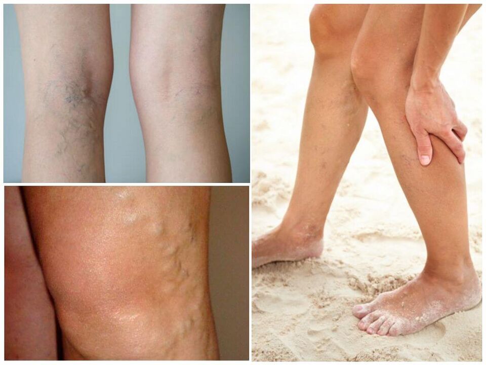 Síntomas de varices