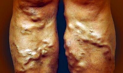Síntomas de varices