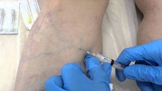 Escleroterapia para varices nas pernas en mulleres