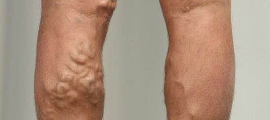 Varices na perna