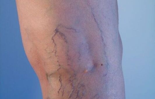 Varices nas pernas nas mulleres