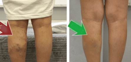 Resultados do tratamento de varices nas pernas