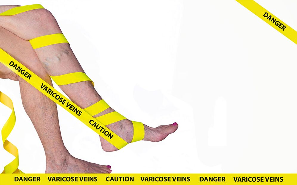 Varices nas pernas