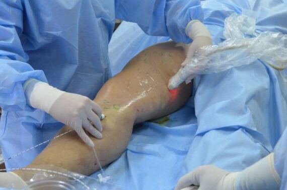 Cirurxía para extirpar varices laterais