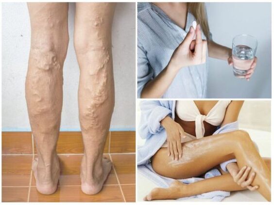 Métodos de tratamento para varices nas pernas