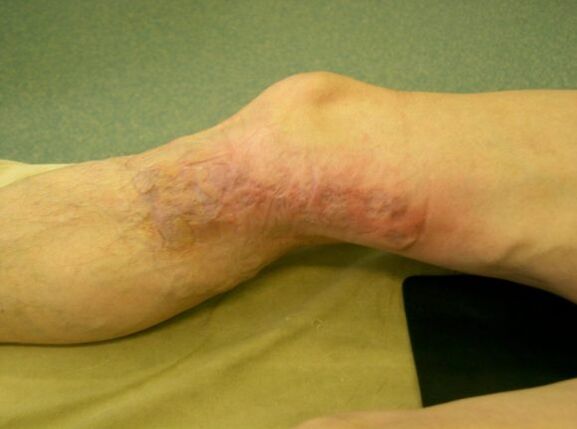 Perna despois da eliminación de varices