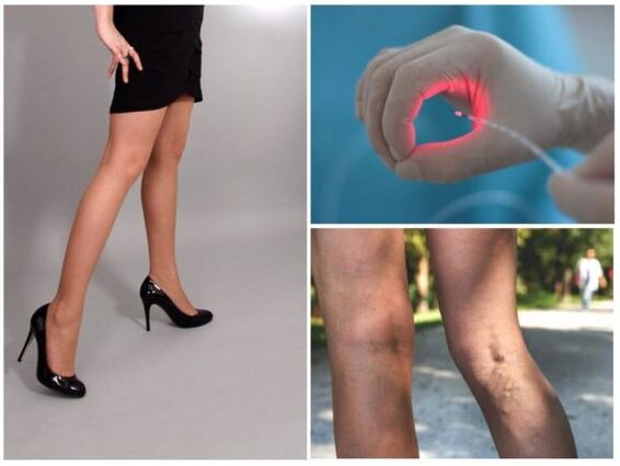 Tratamento con láser de varices nas pernas