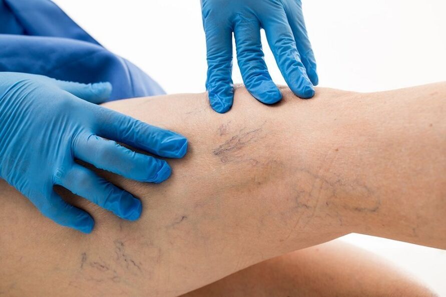 Exame das pernas en busca de varices