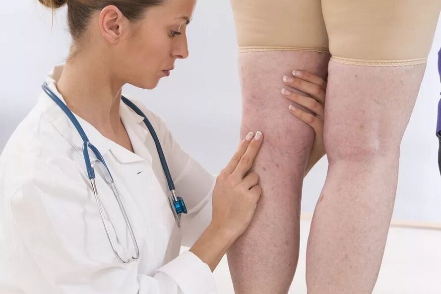 O médico examina as veas en busca de varices