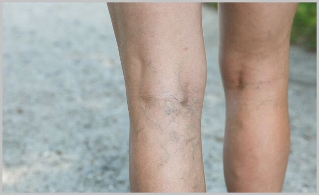 veas das pernas abultadas con varices