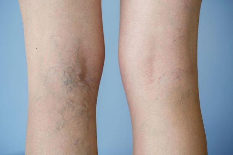 Foto de varices nas pernas