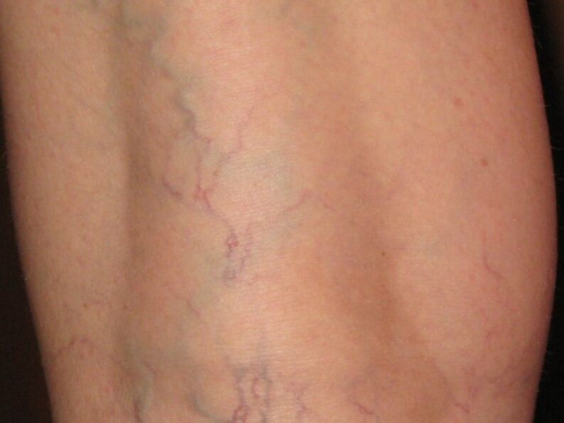 Sinais de varices nas pernas