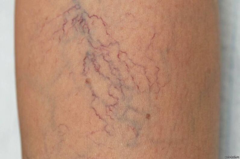 Síntomas de varices nas pernas