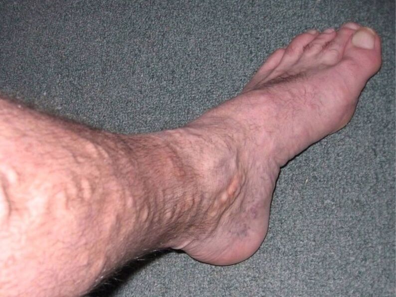 Varices na perna