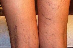 Foto de varices nas pernas
