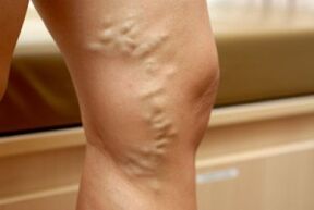 Varices na perna